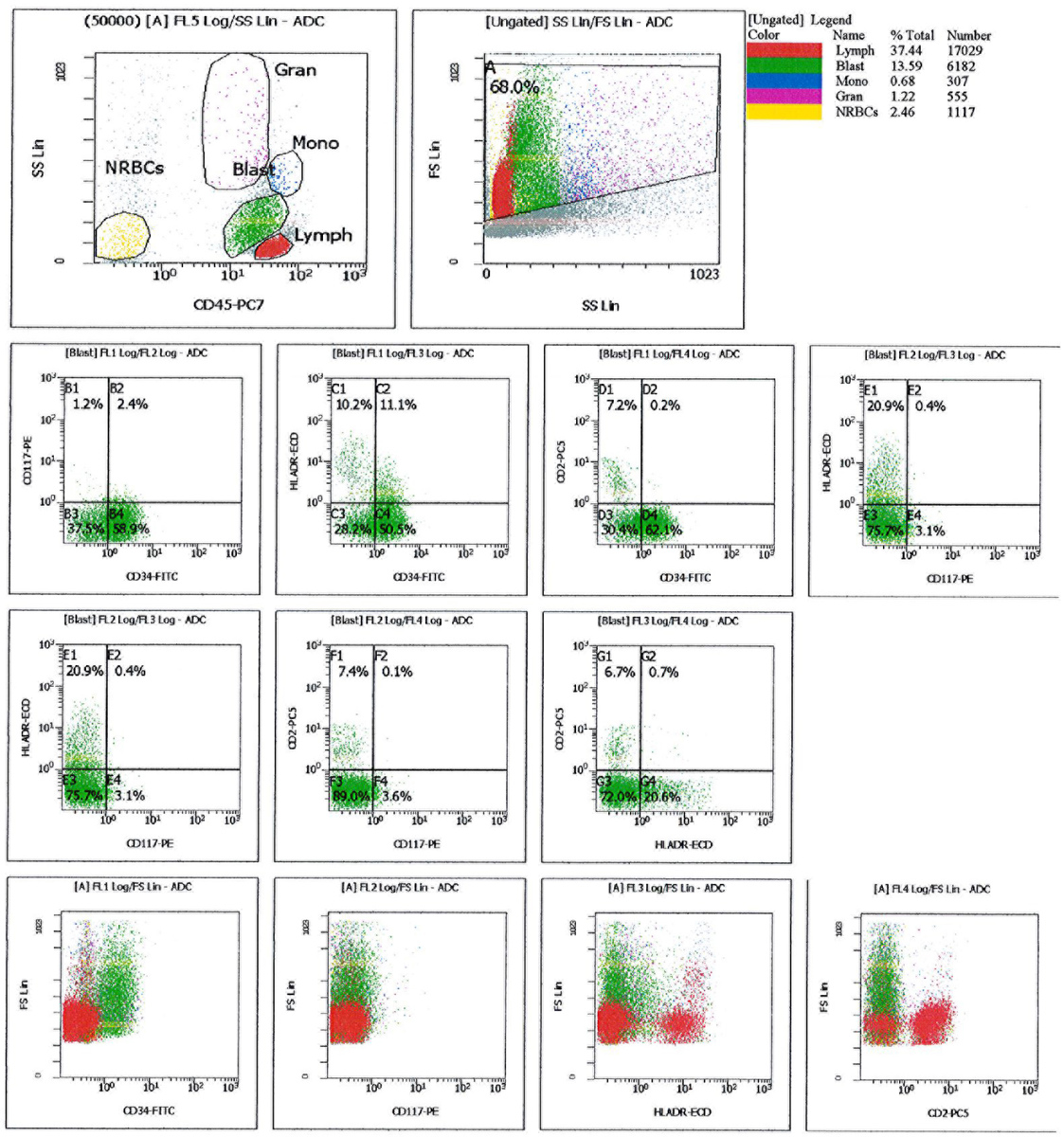 Flow cytometry of the FNA from pelvic lymph node showing that blasts are CD34+ and have borderline expression of HLA-DR
